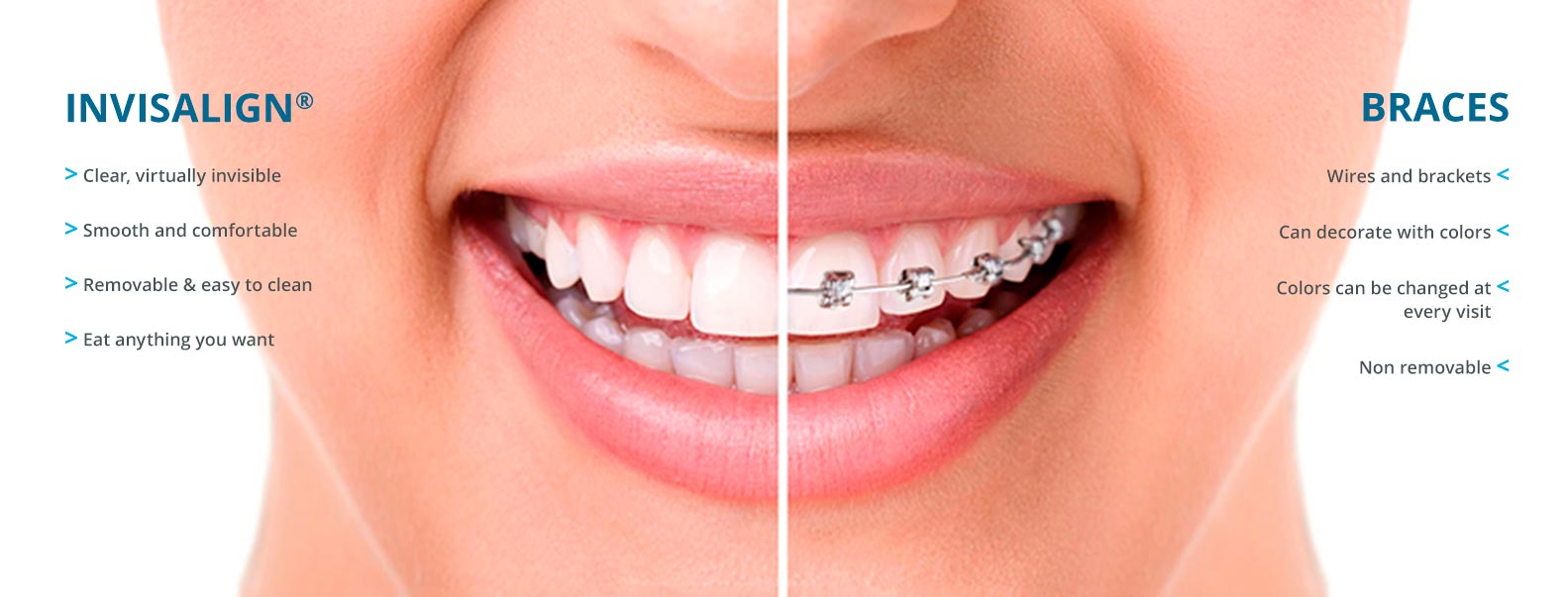 Steele Creek Invisalign Clear Braces