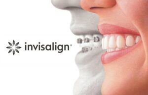 invisalign clear braces