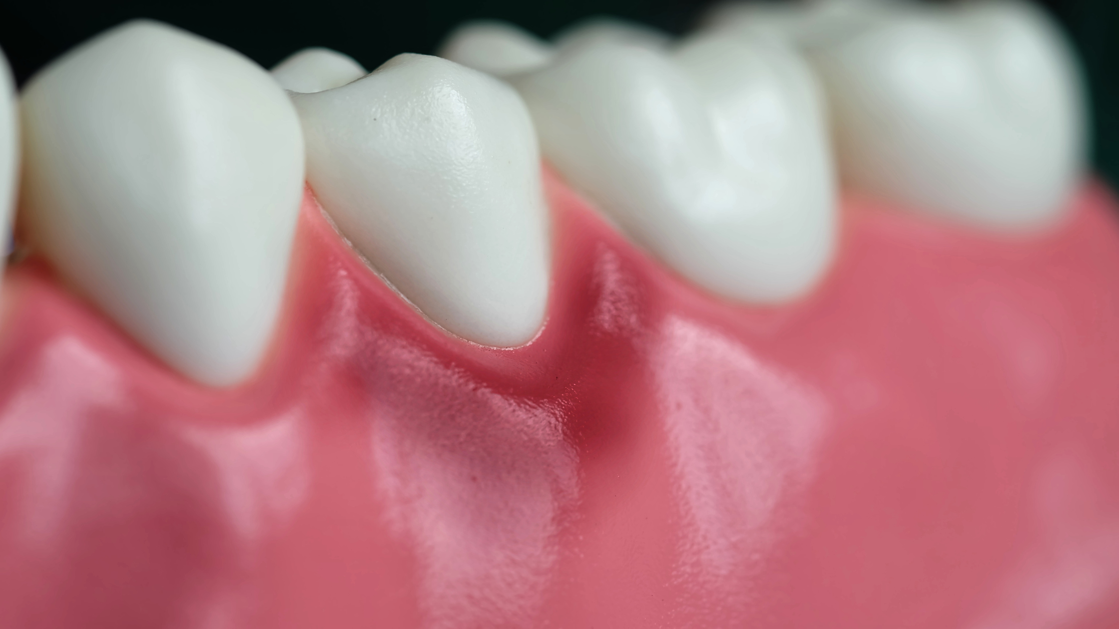 Steele Creek Gum Disease