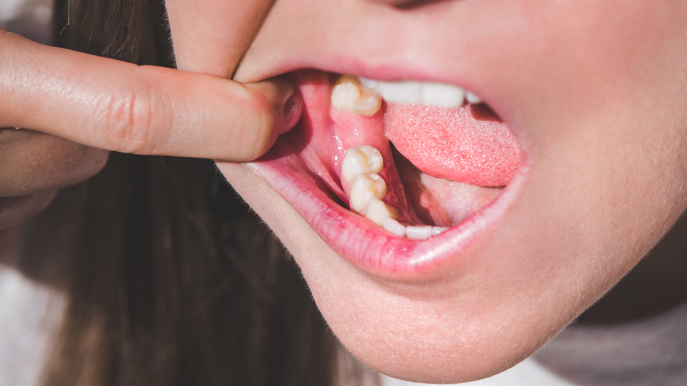 Tooth Extraction: A Step-By-Step Guide For A Smooth Experience
