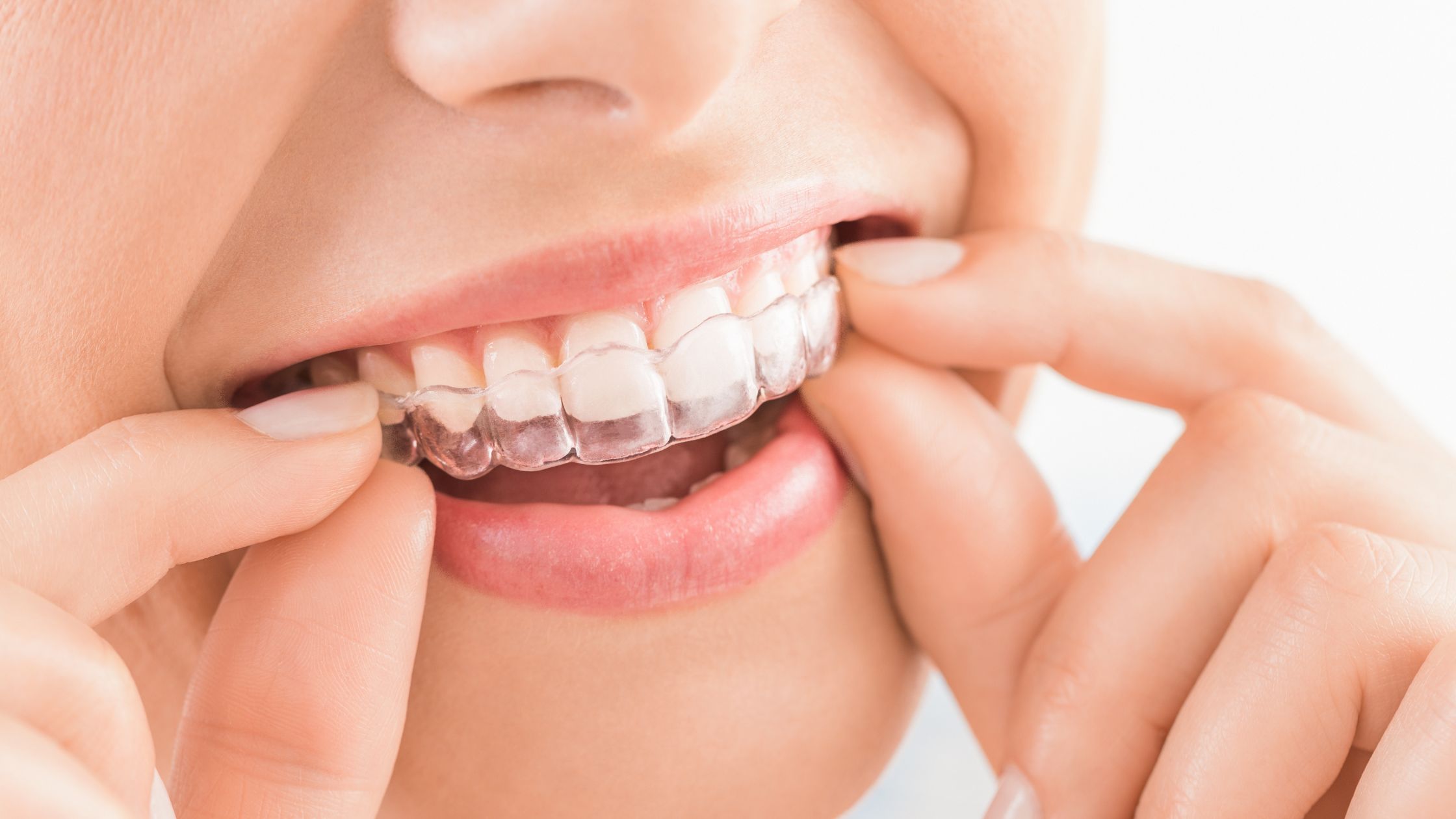 Invisalign Treatment In Charlotte, NC