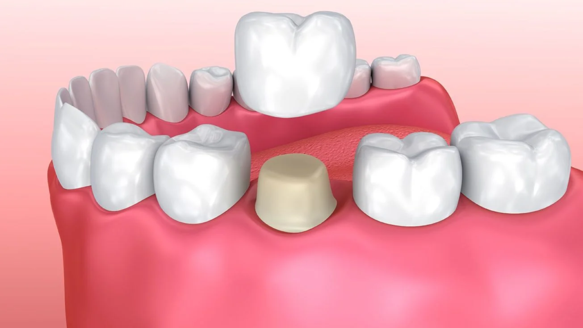 Porcelain-Dental-Crowns-Restore-Your-Smile-in-Confidence