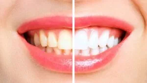 Teeth Whitening Charlotte NC Steele Creek Smiles