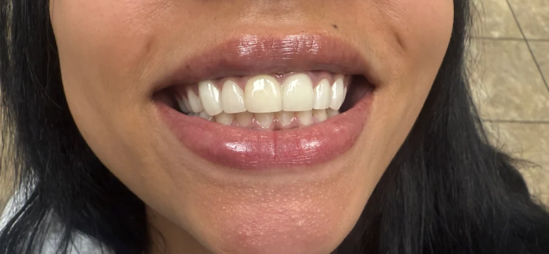 After Dental Veneers