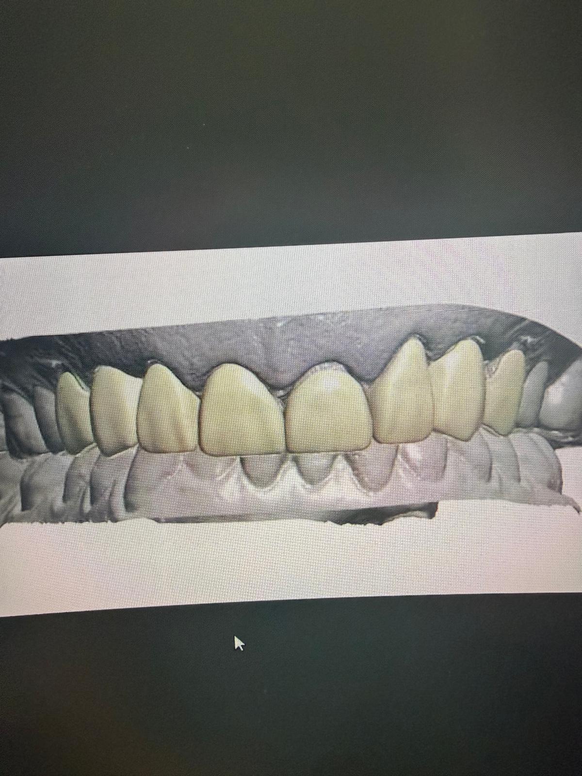 Digital smile design preview, Digital view