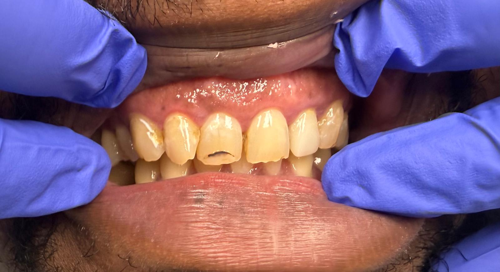 Worn and shortened front teeth before full mouth rehabilitation