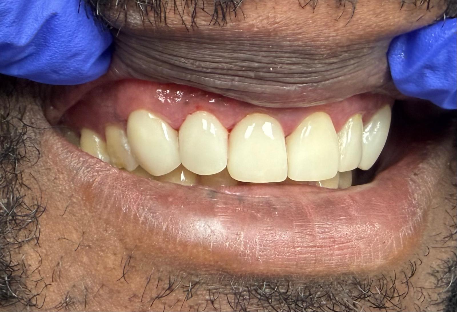 Digital smile design mockup used to plan the rehabilitation