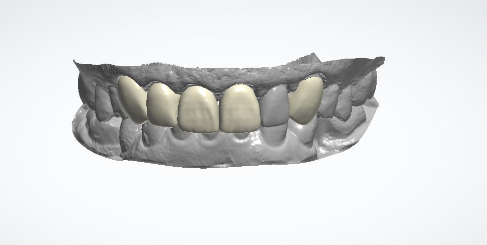 Digital smile design veneer mockup