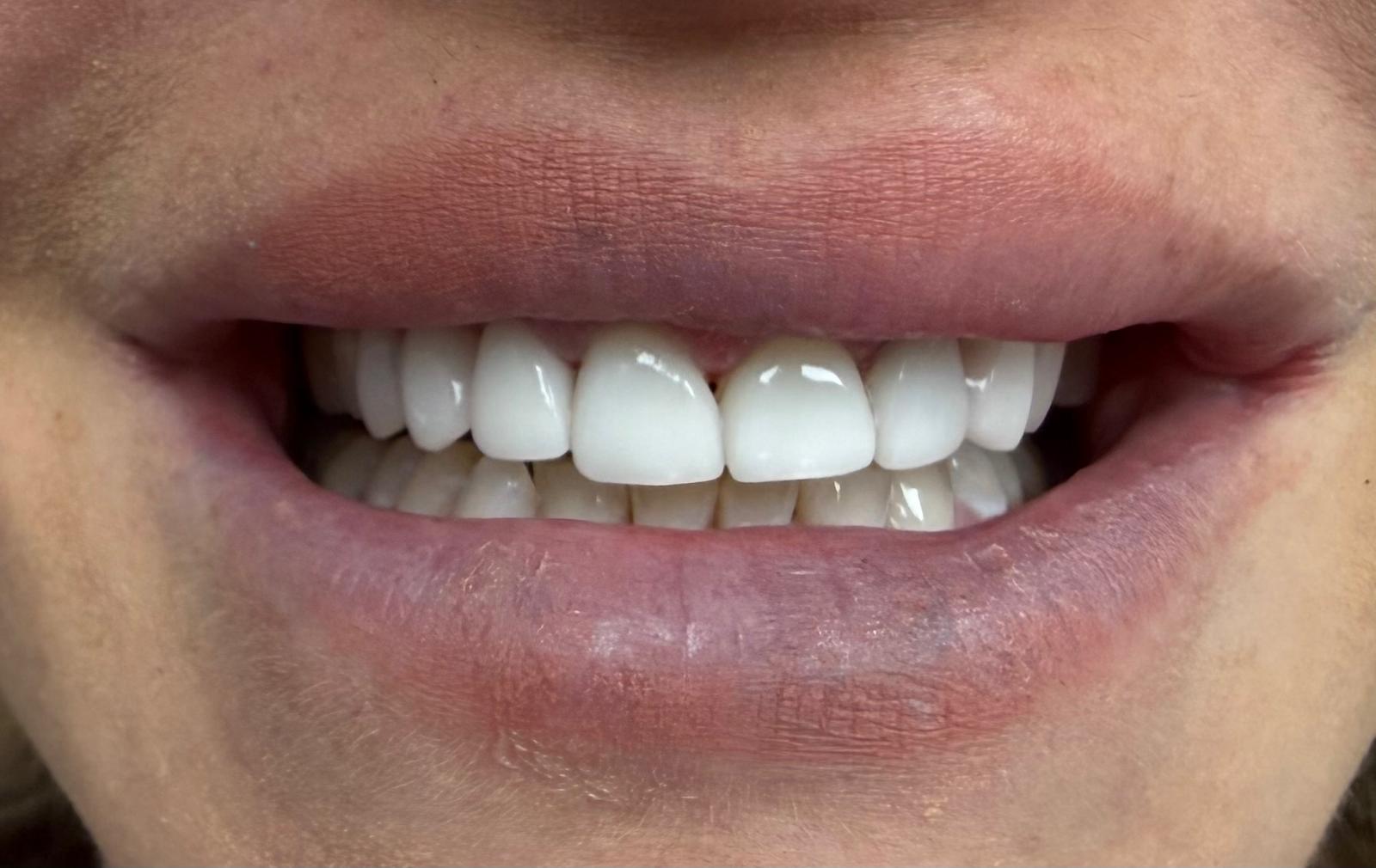 Bright, natural-looking smile after E.max crown restorations, front view