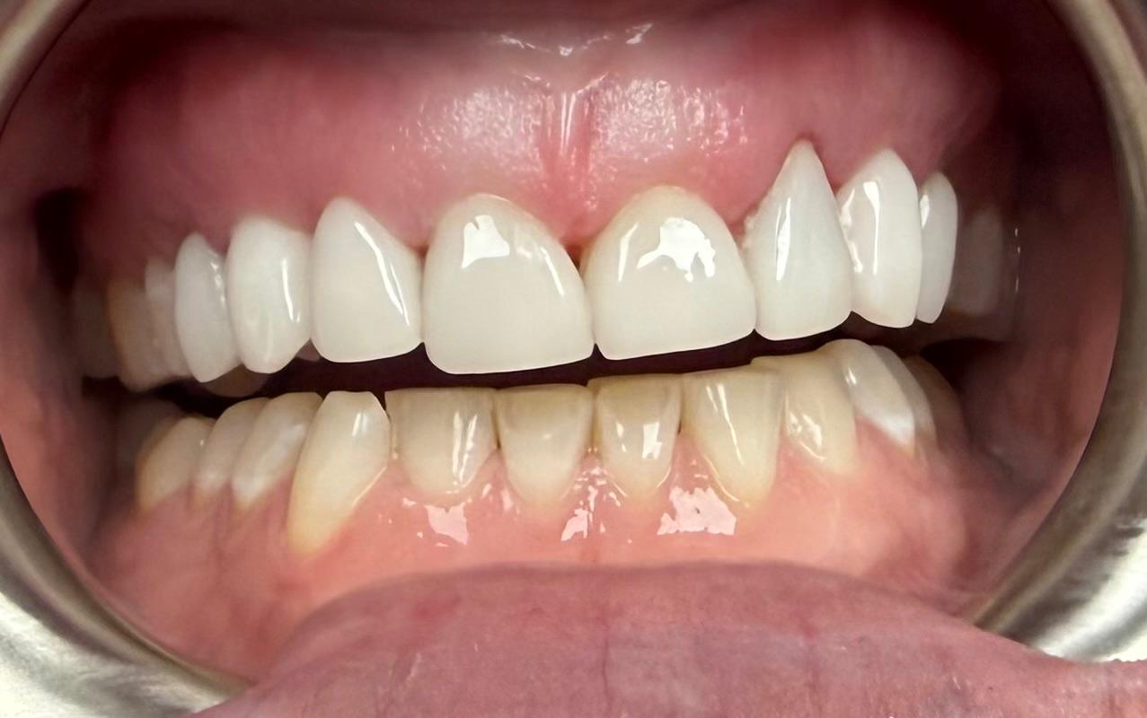 Porcelain veneers after treatment, intraoral view