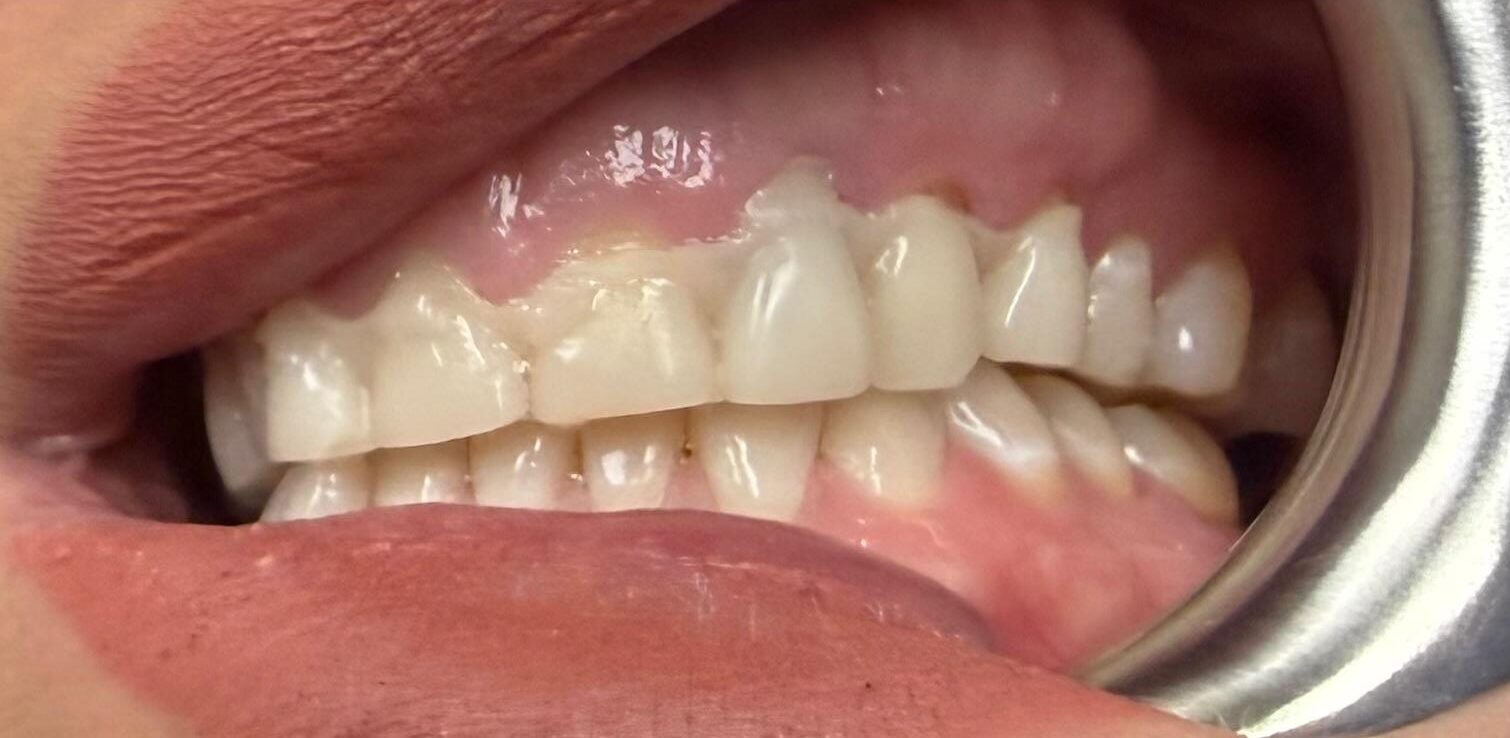 Final restorations side view after treatment