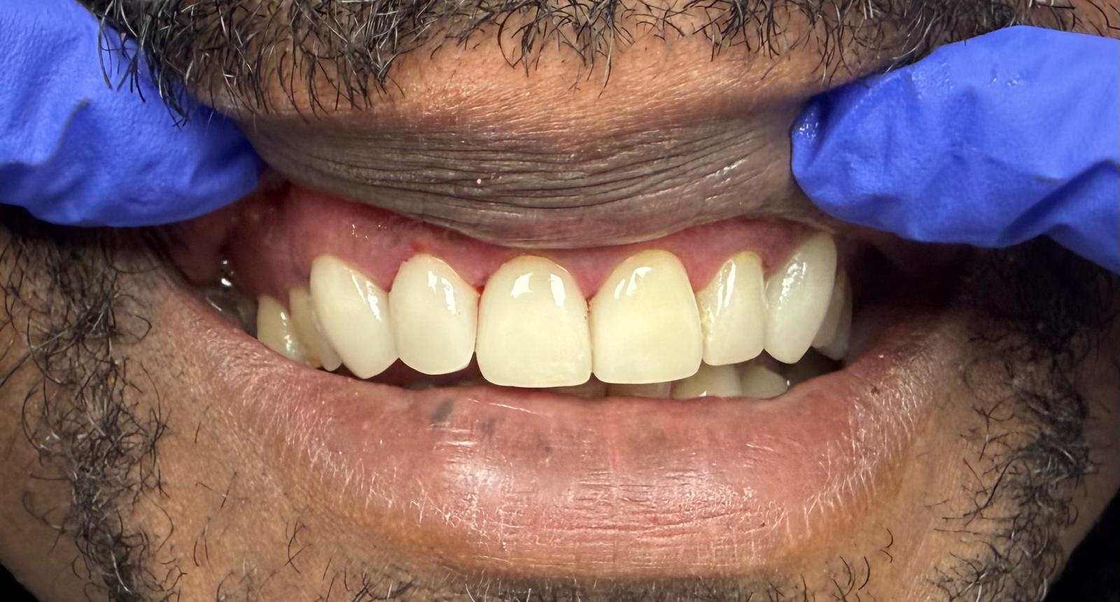 Bright, full and symmetrical smile after porcelain veneers and E.max crowns