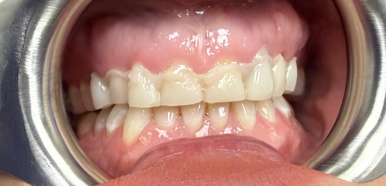 Digital smile design preview used to plan the final restorations