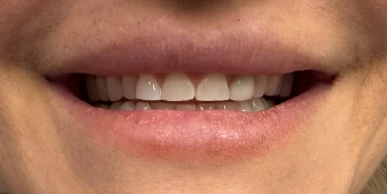 Stained and crowded upper front teeth before treatment, front view