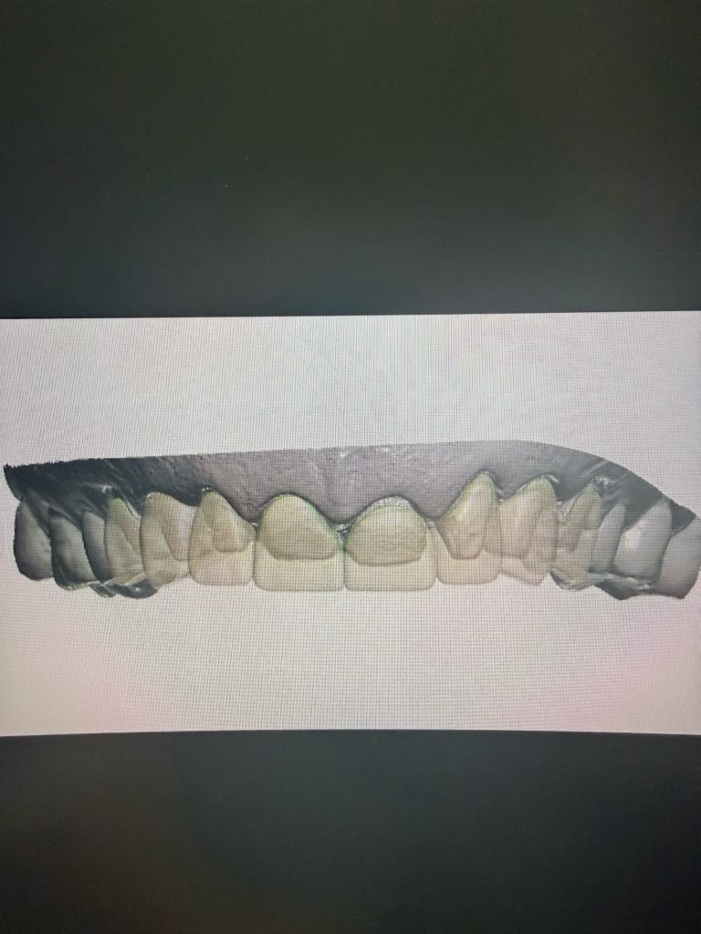 Digital smile design preview