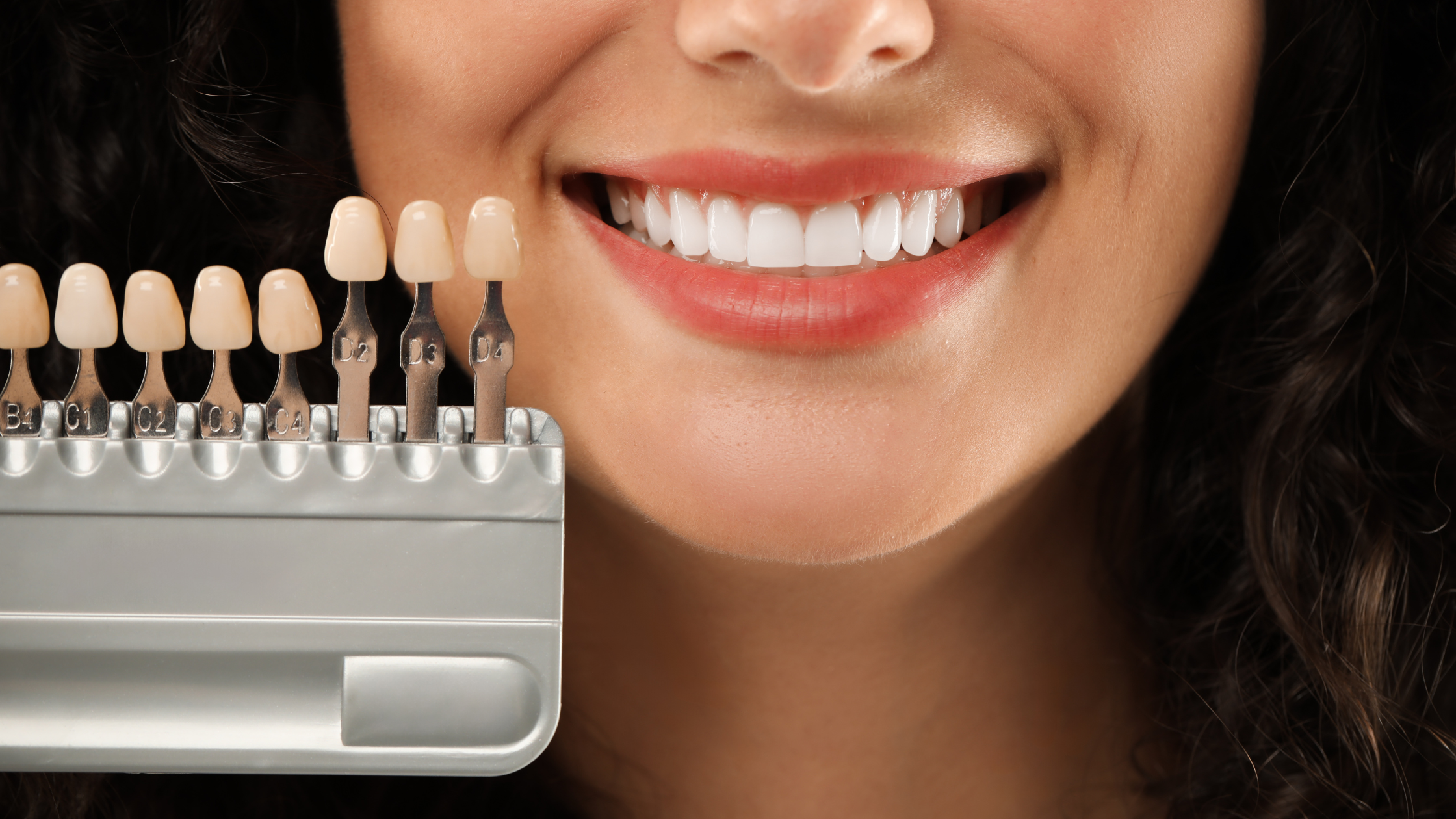 Am I a Candidate for Veneers