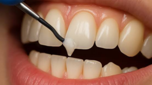 Dental Bonding for Chipped Teeth