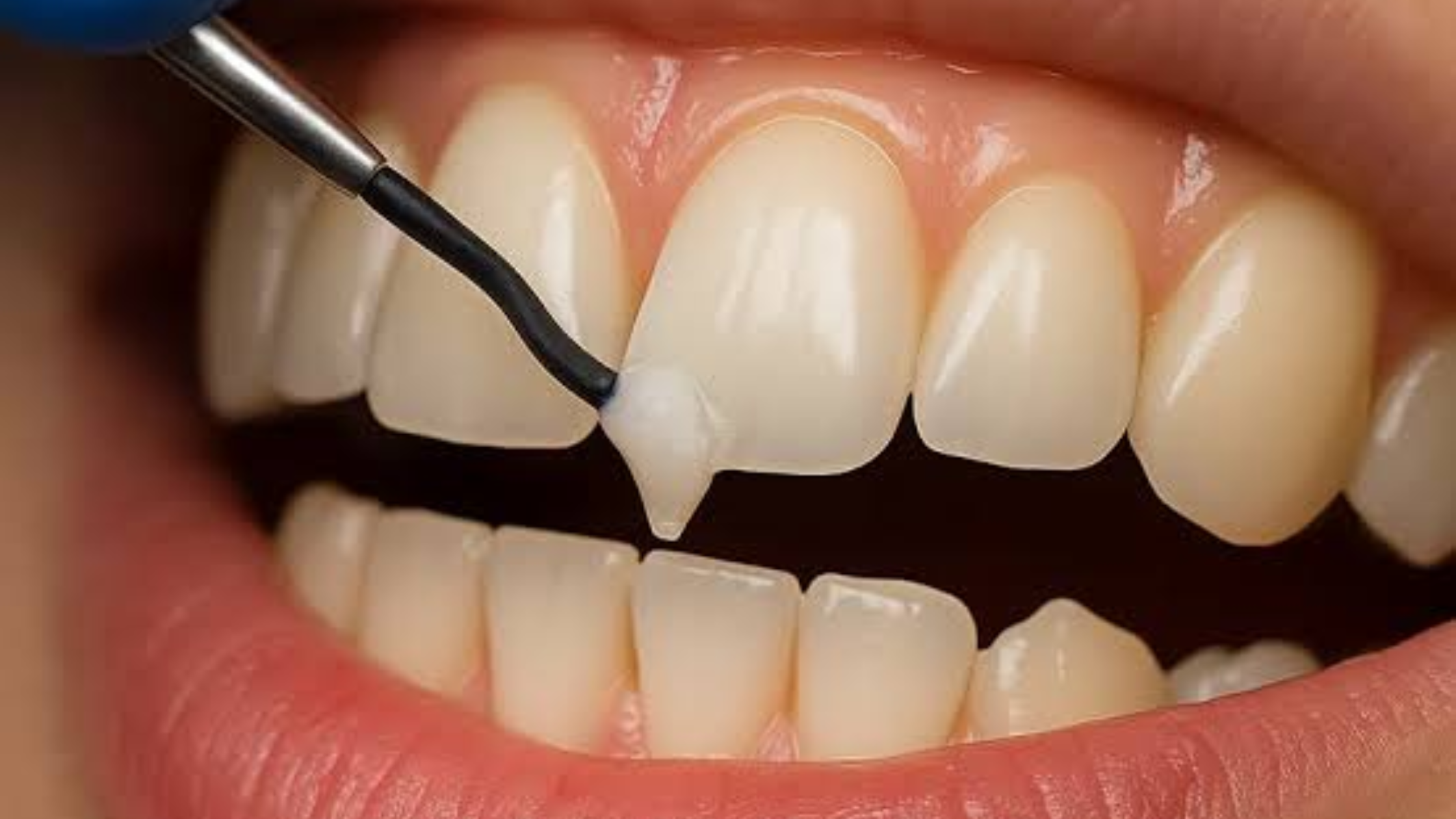 Dental Bonding for Chipped Teeth