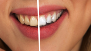 In-Office vs. At-Home Teeth Whitening