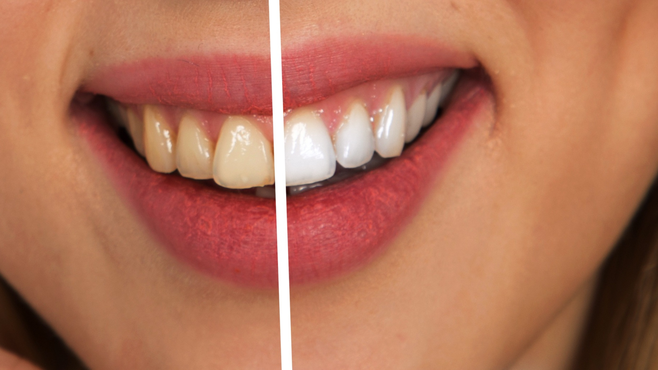 In-Office vs. At-Home Teeth Whitening