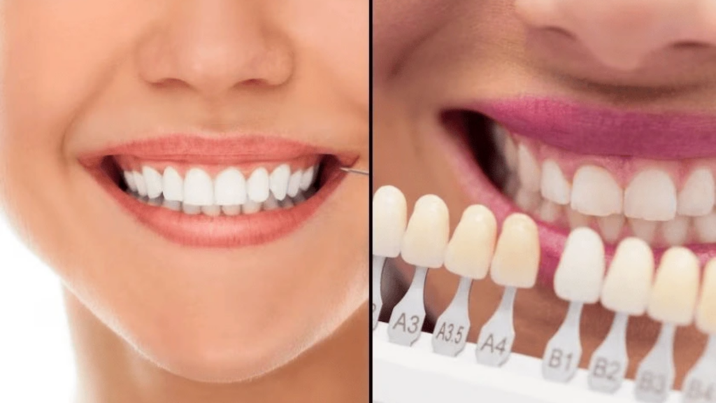 Teeth Whitening vs. Veneers: How to Choose the Right Fix for a Dull Smile