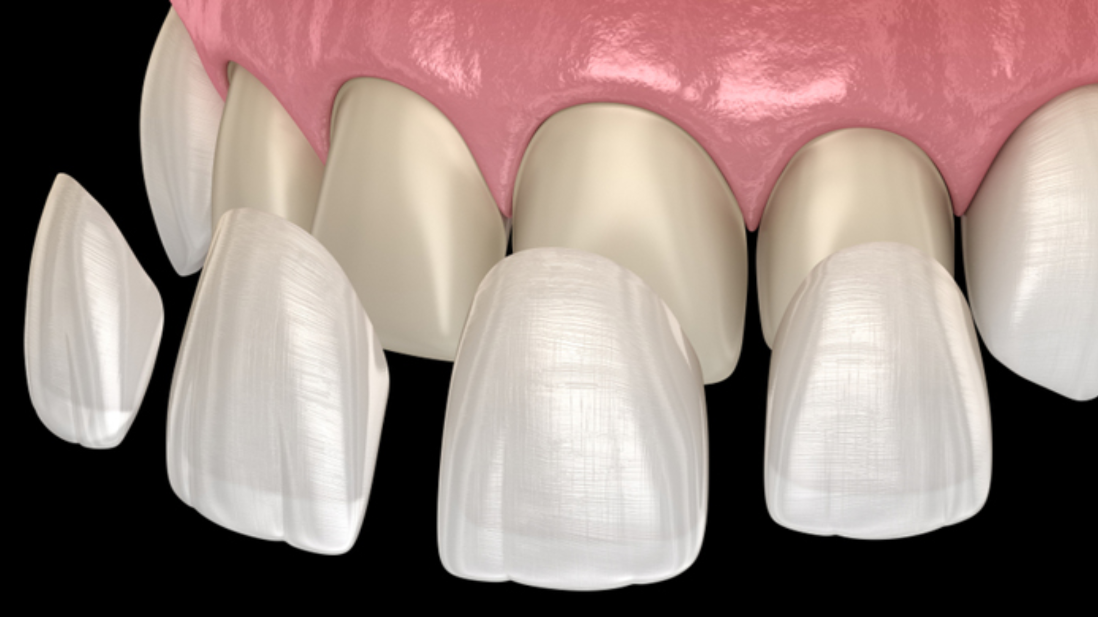 What-to-Expect-at-a-Porcelain-Veneers-Consultation